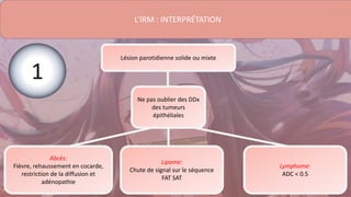 L’IRM : INTERPRÉTATION
Ne pas oublier des DDx
des tumeurs
épithéliales
Lésion parotidienne solide ou mixte
Abcès:
Fièvre, rehaussement en cocarde,
restriction de la diffusion et
adénopathie
Lymphome:
ADC < 0.5
Lipome:
Chute de signal sur le séquence
FAT SAT
1
 