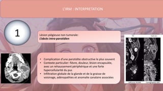 L’IRM : INTERPRETATION
Lésion piégieuse non tumorale:
L’abcès intra-parotidien
• Complication d’une parotidite obstructive le plus souvent
• Contexte particulier: fièvre, douleur, lésion encapsulée,
avec un rehaussement périphérique et une forte
hypercellularité du pus
• Infiltration globale de la glande et de la graisse de
voisinage, adénopathies et anomalie canalaire associées
1
 