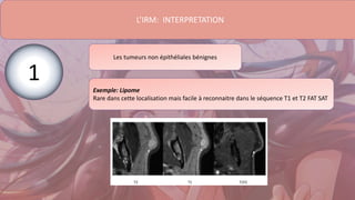 L’IRM: INTERPRETATION
Les tumeurs non épithéliales bénignes
Exemple: Lipome
Rare dans cette localisation mais facile à reconnaitre dans le séquence T1 et T2 FAT SAT
1
 