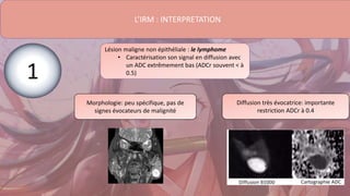 L’IRM : INTERPRETATION
Lésion maligne non épithéliale : le lymphome
• Caractérisation son signal en diffusion avec
un ADC extrêmement bas (ADCr souvent < à
0.5)
Morphologie: peu spécifique, pas de
signes évocateurs de malignité
Diffusion très évocatrice: importante
restriction ADCr à 0.4
1
 