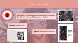 L’IRM : INTERPRETATION
Morphologie: hétérogène avec centre nécrotique (*), hyposignal
T2, mal limitée infiltrante (flèche), contours réguliers
Perfusion: courbe de type C
Diffusion: restriction de la diffusion
2
 
