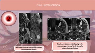 L’IRM : INTERPRETATION
2
Adénocarcinome mucoépidermoïde:
contours mal limités
Carcinome épidemoïde haut grade:
extension péri-neural de la branche
trigerminale et faciale
 