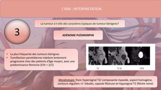 L’IRM : INTERPRETATION
La tumeur a-t-elle des caractères typiques de tumeur bénignes?
• La plus fréquente des tumeurs bénignes
• Tuméfaction parotidienne indolore lentement
progressive chez des patients d’âge moyen, avec une
prédominance féminine (F/H = 2/1)
ADÉNOME PLÉOMORPHE
Morphologie: franc hypersignal T2/ composante myxoide, aspect homogène,
contours réguliers +/- lobulés, capsule fibreuse en hyposignal T2 (flèche noire)
3
 