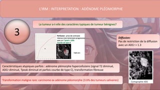 L’IRM : INTERPRETATION : ADÉNOME PLÉOMORPHE
La tumeur a-t-elle des caractères typiques de tumeur bénignes?
Diffusion:
Pas de restriction de la diffusion
avec un ADCr > 1.3
Caractéristiques atypiques parfois : adénome plémorphe hypercellulaire (signal T2 diminué,
ADCr diminué, Tpeak diminué et parfois courbe de type C), transformation fibreuse
Transformation maligne rare: carcinome ex adénome pléomorphe (3.6% des tumeurs salivaires)
3
 