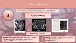 L’IRM : INTERPRETATION
La tumeur a-t-elle des caractères typiques de tumeur bénignes?
Diffusion: restriction de la diffusion avec un ADCr souvent <
1! Ce qui rend difficile la distinction avec les tumeurs
malignes ici, ADCr dans la portion solide
Perfusion: prise de contraste intense et précoce
suivie d’un wash-out > 30%
Courbe de type B
TUMEUR DE WARTHIN
3
Morphologie: hypersignal T1
 