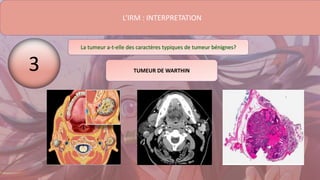 L’IRM : INTERPRETATION
La tumeur a-t-elle des caractères typiques de tumeur bénignes?
3 TUMEUR DE WARTHIN
 