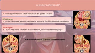 quelques generalités
 Tumeurs parotidiennnes = 70% des tumeurs des glandes salivaires
80% bénignes
 Les plus fréquentes: adénome pléomorphe, tumeur de Warthin ou Cystadénolymphome
20% malignes
 Les plus fréquentes: carcinome mucoépidemoide, carcinome adénoide kystique
WHO classification (2017) : grande variété histologique
QUELQUES GENERALITES
 
