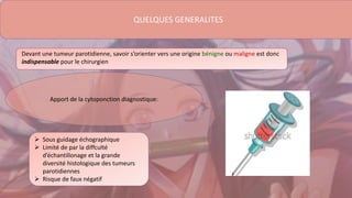 QUELQUES GENERALITES
Devant une tumeur parotidienne, savoir s’orienter vers une origine bénigne ou maligne est donc
indispensable pour le chirurgien
Apport de la cytoponction diagnostique:
 Sous guidage échographique
 Limité de par la diffculté
d’échantillonage et la grande
diversité histologique des tumeurs
parotidiennes
 Risque de faux négatif
 