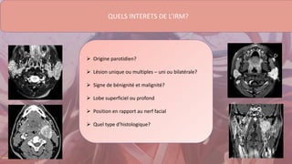 QUELS INTERETS DE L’IRM?
 Origine parotidien?
 Lésion unique ou multiples – uni ou bilatérale?
 Signe de bénignité et malignité?
 Lobe superficiel ou profond
 Position en rapport au nerf facial
 Quel type d’histologique?
 