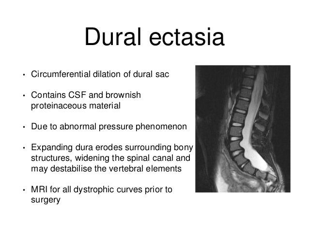 Neurofibromatosis and the spine