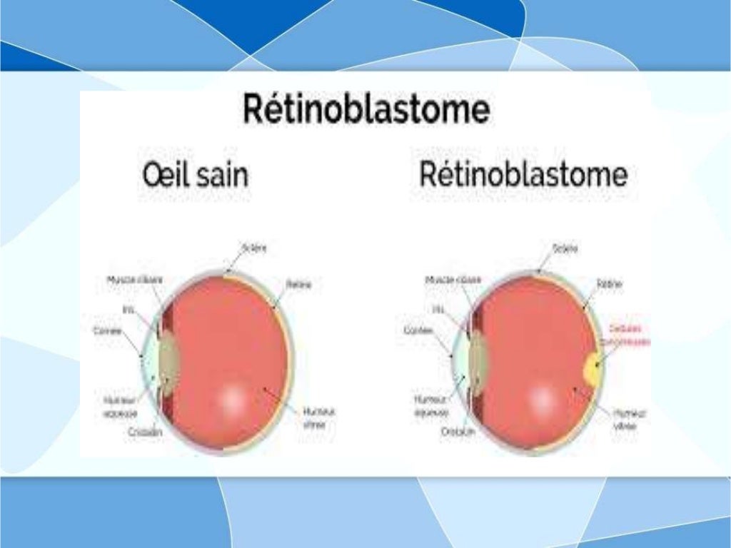 Retinoblastoma