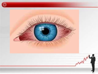 Red eye