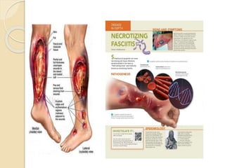 Necrotizing fasciitis Case presentation 