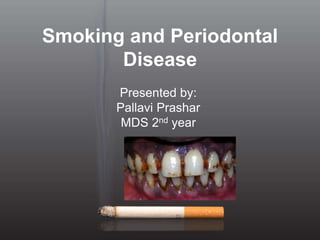 Smoking and Periodontal
Disease
Presented by:
Pallavi Prashar
MDS 2nd year
 