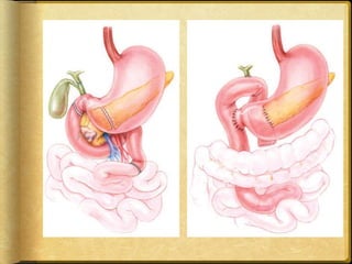 pancreatic cancer: surgical resection | PPTX