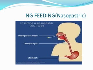 NG FEEDING(Nasogastric)
 