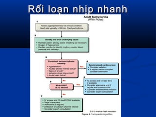 Rối loạn nhịp nhanhRối loạn nhịp nhanh
 