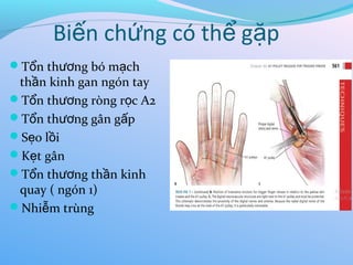 Bi n ch ng có th g p
ế ứ ể ặ
T n th ng bó m ch
ổ ươ ạ
th n kinh gan ngón tay
ầ
T n th ng ròng r c A2
ổ ươ ọ
T n th ng gân g p
ổ ươ ấ
S o l i
ẹ ồ
K t gân
ẹ
T n th ng th n kinh
ổ ươ ầ
quay ( ngón 1)
Nhi m trùng
ễ
 