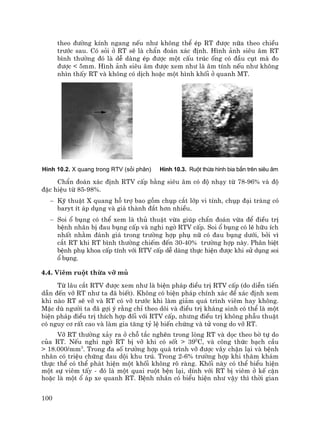 100
theo ®−êng kÝnh ngang nÕu nh− kh«ng thÓ Ðp RT ®−îc n÷a theo chiÒu
tr−íc sau. Cã sái ë RT sÏ lµ chÈn ®o¸n x¸c ®Þnh. H×nh ¶nh siªu ©m RT
b×nh th−êng ®ã lµ dÔ dµng Ðp ®−îc mét cÊu tróc èng cã ®Çu côt mµ ®o
®−îc < 5mm. H×nh ¶nh siªu ©m ®−îc xem nh− lµ ©m tÝnh nÕu nh− kh«ng
nh×n thÊy RT vµ kh«ng cã dÞch hoÆc mét h×nh khèi ë quanh MT.
H×nh 10.2. X quang trong RTV (sái ph©n) H×nh 10.3. Ruét thõa h×nh bia b¾n trªn siªu ©m
ChÈn ®o¸n x¸c ®Þnh RTV cÊp b»ng siªu ©m cã ®é nh¹y tõ 78-96% vµ ®é
®Æc hiÖu tõ 85-98%.
− Kü thuËt X quang hç trî bao gåm chôp c¾t líp vi tÝnh, chôp ®¹i trµng cã
baryt Ýt ¸p dông vµ gi¸ thµnh ®¾t h¬n nhiÒu.
− Soi æ bông cã thÓ xem lµ thñ thuËt võa gióp chÈn ®o¸n võa ®Ó ®iÒu trÞ
bÖnh nh©n bÞ ®au bông cÊp vµ nghi ngê RTV cÊp. Soi æ bông cã lÏ h÷u Ých
nhÊt nh»m ®¸nh gi¸ trong tr−êng hîp phô n÷ cã ®au bông d−íi, bëi v×
c¾t RT khi RT b×nh th−êng chiÕm ®Õn 30-40% tr−êng hîp nµy. Ph©n biÖt
bÖnh phô khoa cÊp tÝnh víi RTV cÊp dÔ dµng thùc hiÖn ®−îc khi sö dông soi
æ bông.
4.4. Viªm ruét thõa vì mñ
Tõ l©u c¾t RTV ®−îc xem nh− lµ biÖn ph¸p ®iÒu trÞ RTV cÊp (do diÔn tiÕn
dÉn ®Õn vì RT nh− ta ®· biÕt). Kh«ng cã biÖn ph¸p chÝnh x¸c ®Ó x¸c ®Þnh xem
khi nµo RT sÏ vì vµ RT cã vì tr−íc khi lµm gi¶m qu¸ tr×nh viªm hay kh«ng.
MÆc dï ng−êi ta ®· gîi ý r»ng chØ theo dâi vµ ®iÒu trÞ kh¸ng sinh cã thÓ lµ mét
biÖn ph¸p ®iÒu trÞ thÝch hîp ®èi víi RTV cÊp, nh−ng ®iÒu trÞ kh«ng phÉu thuËt
cã nguy c¬ rÊt cao vµ lµm gia t¨ng tû lÖ biÕn chøng vµ tö vong do vì RT.
Vì RT th−êng x¶y ra ë chç t¾c nghÏn trong lßng RT vµ däc theo bê tù do
cña RT. NÕu nghi ngê RT bÞ vì khi cã sèt > 390
C, vµ c«ng thøc b¹ch cÇu
> 18.000/mm3
. Trong ®a sè tr−êng hîp qu¸ tr×nh vì ®−îc v©y chÆn l¹i vµ bÖnh
nh©n cã triÖu chøng ®au déi khu tró. Trong 2-6% tr−êng hîp khi th¨m kh¸m
thùc thÓ cã thÓ ph¸t hiÖn mét khèi kh«ng râ rµng. Khèi nµy cã thÓ biÓu hiÖn
mét sù viªm tÊy - ®ã lµ mét quai ruét bÖn l¹i, dÝnh víi RT bÞ viªm ë kÕ cËn
hoÆc lµ mét æ ¸p xe quanh RT. BÖnh nh©n cã biÓu hiÖn nh− vËy th× thêi gian
 