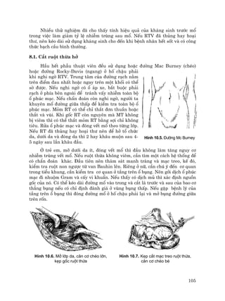 105
NhiÒu thö nghiÖm ®· cho thÊy tÝnh hiÖu qu¶ cña kh¸ng sinh tr−íc mæ
trong viÖc lµm gi¶m tû lÖ nhiÔm trïng sau mæ. NÕu RTV ®· thñng hay ho¹i
th−, nªn kÐo dµi sö dông kh¸ng sinh cho ®Õn khi bÖnh nh©n hÕt sèt vµ cã c«ng
thøc b¹ch cÇu b×nh th−êng.
8.1. C¾t ruét thõa hë
HÇu hÕt phÉu thuËt viªn ®Òu sö dông hoÆc ®−êng Mac Burney (chÐo)
hoÆc ®−êng Rocky-Davis (ngang) ë hè chËu ph¶i
khi nghi ngê RTV. Trung t©m cña ®−êng r¹ch n»m
trªn ®iÓm ®au nhÊt hoÆc ngay trªn mét khèi cã thÓ
sê ®−îc. NÕu nghi ngê cã æ ¸p xe, b¾t buéc ph¶i
r¹ch ë phÝa bªn ngoµi ®Ó tr¸nh vÊy nhiÔm toµn bé
æ phóc m¹c. NÕu chÈn ®o¸n cßn nghi ngê, ng−êi ta
khuyªn mæ ®−êng gi÷a thÊp ®Ó kiÓm tra toµn bé æ
phóc m¹c. Mám RT cã thÓ chØ th¾t ®¬n thuÇn hoÆc
th¾t vµ vïi. Khi gèc RT cßn nguyªn mµ MT kh«ng
bÞ viªm th× cã thÓ th¾t mám RT b»ng sîi chØ kh«ng
tiªu. Röa æ phóc m¹c vµ ®ãng vÕt mæ theo tõng líp.
NÕu RT ®· thñng hay ho¹i th− nªn ®Ó hë tæ chøc
da, d−íi da vµ ®ãng da th× 2 hay kh©u muén sau 4-
5 ngµy sau lÇn kh©u ®Çu.
ë trÎ em, mì d−íi da Ýt, ®ãng vÕt mæ th× ®Çu kh«ng lµm t¨ng nguy c¬
nhiÔm trïng vÕt mæ. NÕu ruét thõa kh«ng viªm, cÇn t×m mét c¸ch hÖ thèng ®Ó
cã chÈn ®o¸n kh¸c. §Çu tiªn nªn th¸m s¸t manh trµng vµ m¹c treo, kÕ ®ã,
kiÓm tra ruét non ng−îc tõ van Bauhin lªn. Riªng ë n÷, cÇn chó ý ®Õn c¬ quan
trong tiÓu khung, cÇn kiÓm tra c¬ quan ë tÇng trªn æ bông. Nªn gëi dÞch æ phóc
m¹c ®i nhuém Gram vµ cÊy vi khuÈn. NÕu thÊy cã dÞch mñ th× x¸c ®Þnh nguån
gèc cña nã. Cã thÓ kÐo dµi ®−êng mæ vµo trong vµ c¾t l¸ tr−íc vµ sau cña bao c¬
th¼ng bông nÕu cã chØ ®Þnh ®¸nh gi¸ ë vïng bông thÊp. NÕu gÆp bÖnh lý cña
tÇng trªn æ bông th× ®ãng ®−êng mæ ë hè chËu ph¶i l¹i vµ më bông ®−êng gi÷a
trªn rèn.
H×nh 10.6. Më líp da, c©n c¬ chÐo lín,
kÑp gèc ruét thõa
H×nh 10.7. KÑp c¾t m¹c treo ruét thõa,
c©n c¬ chÐo bÐ
H×nh 10.5. §−êng Mc Burney
 