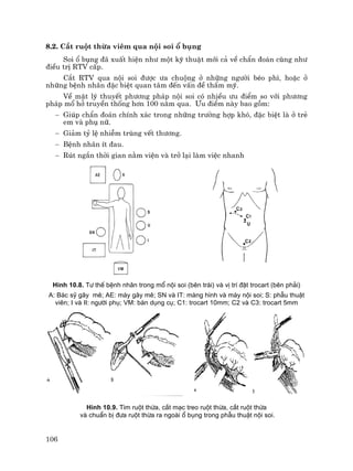 106
8.2. C¾t ruét thõa viªm qua néi soi æ bông
Soi æ bông ®· xuÊt hiÖn nh− mét kü thuËt míi c¶ vÒ chÈn ®o¸n còng nh−
®iÒu trÞ RTV cÊp.
C¾t RTV qua néi soi ®−îc −a chuéng ë nh÷ng ng−êi bÐo ph×, hoÆc ë
nh÷ng bÖnh nh©n ®Æc biÖt quan t©m ®Õn vÊn ®Ò thÈm mü.
VÒ mÆt lý thuyÕt ph−¬ng ph¸p néi soi cã nhiÒu −u ®iÓm so víi ph−¬ng
ph¸p mæ hë truyÒn thèng h¬n 100 n¨m qua. −u ®iÓm nµy bao gåm:
− Gióp chÈn ®o¸n chÝnh x¸c trong nh÷ng tr−êng hîp khã, ®Æc biÖt lµ ë trÎ
em vµ phô n÷.
− Gi¶m tû lÖ nhiÔm trïng vÕt th−¬ng.
− BÖnh nh©n Ýt ®au.
− Rót ng¾n thêi gian n»m viÖn vµ trë l¹i lµm viÖc nhanh
H×nh 10.8. T− thÕ bÖnh nh©n trong mæ néi soi (bªn tr¸i) vµ vÞ trÝ ®Æt trocart (bªn ph¶i)
A: B¸c sü g©y mª; AE: m¸y g©y mª; SN vµ IT: mµng h×nh vµ m¸y néi soi; S: phÉu thuËt
viªn; I vµ II: ng−êi phô; VM: bµn dông cô; C1: trocart 10mm; C2 vµ C3: trocart 5mm
H×nh 10.9. T×m ruét thõa, c¾t m¹c treo ruét thõa, c¾t ruét thõa
vµ chuÈn bÞ ®−a ruét thõa ra ngoµi æ bông trong phÉu thuËt néi soi.
 