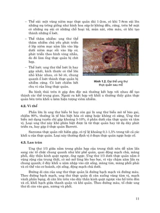 11
− ThÓ sïi: mét vïng niªm m¹c thùc qu¶n dµi 1-2cm, cã khi 7-8cm sïi lªn
nh÷ng nô tr«ng gièng nh− h×nh hoa sóp-l¬ kh«ng ®Òu, cøng, trªn bÒ mÆt
cã nh÷ng nô sïi cã nh÷ng chç ho¹i tö, mñn n¸t, rím m¸u, cã khi t¹o
thµnh nh÷ng æ loÐt.
− ThÓ th©m nhiÔm: ung th− thÓ
th©m nhiÔm chñ yÕu ph¸t triÓn
ë líp niªm m¹c x©m lÊn vµo líp
d−íi niªm m¹c råi vµo líp c¬,
ph¸t triÓn theo h×nh vßng nhÉn,
do ®ã lµm èng thùc qu¶n bÞ chÝt
hÑp.
− ThÓ loÐt: ung th− thÓ loÐt lµ hay
gÆp nhÊt, kÝch th−íc cã thÓ lín
nhá kh¸c nhau, cã bê râ, chung
quanh æ loÐt thµnh thùc qu¶n bÞ
nhiÔm cøng. Cã loÐt chiÕm hÕt
chu vi cña lßng thùc qu¶n.
Ba h×nh th¸i trªn Ýt gÆp ®¬n ®éc mµ th−êng kÕt hîp víi nhau ®Ó t¹o
thµnh c¸c thÓ trung gian. Ngoµi ra kÕt hîp víi khèi u th−êng thÊy gi·n thùc
qu¶n bªn trªn khèi u kÌm hiÖn t−îng viªm nhiÔm.
4.2. Vi thÓ
PhÇn lín lµ ung th− biÓu b× hay cßn gäi lµ ung th− biÓu m« tÕ bµo gai,
chiÕm 90%, th−êng lµ tÕ bµo biÖt hãa cã sõng hoÆc kh«ng cã sõng. Ung th−
biÓu m« d¹ng tuyÕn chØ gÆp kho¶ng 5-10%, ë phÇn d−íi cña thùc qu¶n vµ t©m
vÞ. Lo¹i ung th− nµy khã ph©n biÖt ®−îc lµ tõ thùc qu¶n hay tõ d¹ dµy ph¸t
triÓn ra, hay gÆp ë thùc qu¶n Barrett.
Sarcoma thùc qu¶n rÊt hiÕm gÆp, cã tû lÖ kho¶ng 0,1-1,5% trong tÊt c¶ c¸c
khèi u cña thùc qu¶n. Lo¹i nµy th−êng ®Þnh vÞ ë ®o¹n thùc qu¶n ngùc hoÆc cæ.
4.3. Lan trµn
Ung th− 1/3 gi÷a n»m trong phÇn hÑp cña trung thÊt nªn dÔ x©m lÊn
sang c¸c tæ chøc chung quanh nh− khÝ phÕ qu¶n, quai ®éng m¹ch chñ, mµng
phæi, d©y thÇn kinh quÆt ng−îc, èng ngùc. Ung th− 1/3 d−íi thùc qu¶n n»m ë
vïng réng cña trung thÊt, cã m« mì láng lÎo bao bäc, v× vËy chËm x©m lÊn ra
chung quanh; ë ®©y khèi u x©m nhËp vµo cét sèng, mµng tim, mµng phæi ph¶i
vµ cã thÓ vµo c¬ hoµnh, cét sèng, ®éng m¹ch chñ d−íi.
§−êng di c¨n cña ung th− thùc qu¶n lµ ®−êng b¹ch m¹ch vµ ®−êng m¸u.
Theo ®−êng b¹ch m¹ch, ung th− thùc qu¶n di c¨n xuèng vïng t©m vÞ, m¹ch
vµnh phÇn bông, di c¨n lªn trªn vµo d©y thÇn kinh quÆt ng−îc vµo hè trªn ®ßn
vµ cæ, khèi h¹ch gi÷a thanh qu¶n vµ khÝ qu¶n. Theo ®−êng m¸u, tæ chøc ung
th− di c¨n vµo gan, x−¬ng vµ phæi.
H×nh 1.2. §¹i thÓ ung th−
thùc qu¶n sau mæ
 