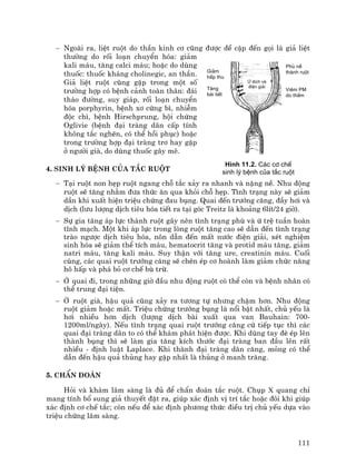 111
− Ngoµi ra, liÖt ruét do thÇn kinh c¬ còng ®−îc ®Ò cËp ®Õn gäi lµ gi¶ liÖt
th−êng do rèi lo¹n chuyÓn hãa: gi¶m
kali m¸u, t¨ng calci m¸u; hoÆc do dïng
thuèc: thuèc kh¸ng cholinegic, an thÇn.
Gi¶ liÖt ruét còng gÆp trong mét sè
tr−êng hîp cã bÖnh c¶nh toµn th©n: ®¸i
th¸o ®−êng, suy gi¸p, rèi lo¹n chuyÓn
hãa porphyrin, bÖnh x¬ cøng b×, nhiÔm
®éc ch×, bÖnh Hirschprung, héi chøng
Oglivie (bÖnh ®¹i trµng d·n cÊp tÝnh
kh«ng t¾c nghÏn, cã thÓ håi phôc) hoÆc
trong tr−êng hîp ®¹i trµng tr¬ hay gÆp
ë ng−êi giµ, do dïng thuèc g©y mª.
4. Sinh lý bÖnh cña t¾c ruét
− T¹i ruét non hÑp ruét ngang chç t¾c x¶y ra nhanh vµ nÆng nÒ. Nhu ®éng
ruét sÏ t¨ng nh»m ®−a thøc ¨n qua khái chç hÑp. T×nh tr¹ng nµy sÏ gi¶m
dÇn khi xuÊt hiÖn triÖu chøng ®au bông. Quai ®Õn tr−íng c¨ng, ®Çy h¬i vµ
dÞch (l−u l−îng dÞch tiªu hãa tiÕt ra t¹i gãc Treitz lµ kho¶ng 6lÝt/24 giê).
− Sù gia t¨ng ¸p lùc thµnh ruét g©y nªn t×nh tr¹ng phï vµ ø trÖ tuÇn hoµn
tÜnh m¹ch. Mét khi ¸p lùc trong lßng ruét t¨ng cao sÏ dÉn ®Õn t×nh tr¹ng
trµo ng−îc dÞch tiªu hãa, n«n dÉn ®Õn mÊt n−íc ®iÖn gi¶i, xÐt nghiÖm
sinh hãa sÏ gi¶m thÓ tÝch m¸u, hematocrit t¨ng vµ protid m¸u t¨ng, gi¶m
natri m¸u, t¨ng kali m¸u. Suy thËn víi t¨ng ure, creatinin m¸u. Cuèi
cïng, c¸c quai ruét tr−íng c¨ng sÏ chÌn Ðp c¬ hoµnh lµm gi¶m chøc n¨ng
h« hÊp vµ ph¸ bá c¬ chÕ bï trõ.
− ë quai ®i, trong nh÷ng giê ®Çu nhu ®éng ruét cã thÓ cßn vµ bÖnh nh©n cã
thÓ trung ®¹i tiÖn.
− ë ruét giµ, hËu qu¶ còng x¶y ra t−¬ng tù nh−ng chËm h¬n. Nhu ®éng
ruét gi¶m hoÆc mÊt. TriÖu chøng tr−íng bông lµ næi bËt nhÊt, chñ yÕu lµ
h¬i nhiÒu h¬n dÞch (l−îng dÞch bµi xuÊt qua van Bauhain: 700-
1200ml/ngµy). NÕu t×nh tr¹ng quai ruét tr−íng c¨ng cø tiÕp tôc th× c¸c
quai ®¹i trµng d·n to cã thÓ kh¸m ph¸t hiÖn ®−îc. Khi dïng tay ®Ì Ðp lªn
thµnh bông th× sÏ lµm gia t¨ng kÝch th−íc ®¹i trµng ban ®Çu lªn rÊt
nhiÒu - ®Þnh luËt Laplace. Khi thµnh ®¹i trµng d·n c¨ng, máng cã thÓ
dÉn ®Õn hËu qu¶ thñng hay gÆp nhÊt lµ thñng ë manh trµng.
5. ChÈn ®o¸n
Hái vµ kh¸m l©m sµng lµ ®ñ ®Ó chÈn ®o¸n t¾c ruét. Chôp x quang chØ
mang tÝnh bæ sung gi¶ thuyÕt ®Æt ra, gióp x¸c ®Þnh vÞ trÝ t¾c hoÆc ®«i khi gióp
x¸c ®Þnh c¬ chÕ t¾c; cßn nÕu ®Ó x¸c ®Þnh ph−¬ng thøc ®iÒu trÞ chñ yÕu dùa vµo
triÖu chøng l©m sµng.
H×nh 11.2. C¸c c¬ chÕ
sinh lý bÖnh cña t¾c ruét
Gi¶m
hÊp thu
T¨ng
bµi tiÕt
Phï nÒ
thµnh ruét
Viªm PM
do thÊm
ø dÞch vµ
®iÖn gi¶i
 