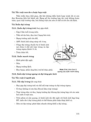 115
7.2. T¾c ruét non do u hoÆc hÑp ruét
TiÕn triÓn theo thêi gian, ®«i khi kh«ng ®iÓn h×nh hoÆc tr−íc ®ã cã c¬n
®au Koenirg (khi hái bÖnh sö). Bông gå lªn tr−êng hîp t¾c ruét kh«ng hoµn
toµn, quai ruét tr−íng võa, l−u th«ng ruét cßn nªn cã thÓ cã Ých cho chØ ®Þnh.
7.3. Xo¾n ®¹i trµng
7.3.1. Xo¾n ®¹i trµng tr¸i: hay gÆp nhÊt
− GÆp ë løa tuæi trung niªn.
− TiÒn sö t¸o bãn, ®au ©m Ø bông bªn tr¸i.
− Bông tr−íng mÊt c©n ®èi.
− ASP: h×nh ¶nh nßng sóng víi 4 trô.
− Chôp ®¹i trµng chuÈn bÞ cã h×nh ¶nh
má chim ë chç nèi trùc trµng vµ ®¹i
trµng sigma (h×nh 11.4).
− Toµn th©n tèt.
7.3.2. Xo¾n manh trµng
− Khëi ph¸t ®ét ngét.
− N«n.
− Bông tr−íng lÖch.
− §au bông ph¶n øng khu tró hè chËu ph¶i.
7.3.3. Xo¾n ®¹i trµng ngang vµ ®¹i tµng gãc l¸ch
7.4. T¾c ruét ë ng−êi giµ
7.4.1. T¾c ®¹i trµng (do ung th−)
− Hay gÆp ®¹i trµng tr¸i vµ chç nèi trùc trµng vµ ®¹i trµng sigma.
− Cã hay kh«ng cã c¬n ®au Duval (®au trùc trµng).
− Trùc trµng d·n vµ ®au, bông tr−íng däc khung ®¹i trµng hîp víi c¸c møc
h¬i n−íc ë ruét non.
− Trªn phim cã c¶n quang, cã h×nh ¶nh t¾c ®ét ngét víi h×nh ¶nh hÑp lßng
§T. (nÕu t¾c ë ®¹i trµng ph¶i cã thÓ kh¸m ph¸t hiÖn ®−îc khèi u).
− Nªn soi ®¹i trµng: ph¸t hiÖn nhanh chãng khèi u ®¹i trµng.
H×nh 11.4. H×nh ¶nh X
quang cña xo¾n manh trµng
 