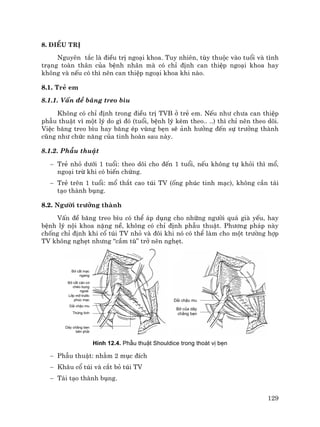 129
8. §iÒu trÞ
Nguyªn t¾c lµ ®iÒu trÞ ngo¹i khoa. Tuy nhiªn, tïy thuéc vµo tuæi vµ t×nh
tr¹ng toµn th©n cña bÖnh nh©n mµ cã chØ ®Þnh can thiÖp ngo¹i khoa hay
kh«ng vµ nÕu cã th× nªn can thiÖp ngo¹i khoa khi nµo.
8.1. TrÎ em
8.1.1. VÊn ®Ò b¨ng treo b×u
Kh«ng cã chØ ®Þnh trong ®iÒu trÞ TVB ë trÎ em. NÕu nh− ch−a can thiÖp
phÉu thuËt v× mét lý do g× ®ã (tuæi, bÖnh lý kÌm theo.. ..) th× chØ nªn theo dâi.
ViÖc b¨ng treo b×u hay b¨ng Ðp vïng bÑn sÏ ¶nh h−ëng ®Õn sù tr−ëng thµnh
còng nh− chøc n¨ng cña tinh hoµn sau nµy.
8.1.2. PhÉu thuËt
− TrÎ nhá d−íi 1 tuæi: theo dâi cho ®Õn 1 tuæi, nÕu kh«ng tù khái th× mæ,
ngo¹i trõ khi cã biÕn chøng.
− TrÎ trªn 1 tuæi: mæ th¾t cao tói TV (èng phóc tinh m¹c), kh«ng cÇn t¸i
t¹o thµnh bông.
8.2. Ng−êi tr−ëng thµnh
VÊn ®Ò b¨ng treo b×u cã thÓ ¸p dông cho nh÷ng ng−êi qu¸ giµ yÕu, hay
bÖnh lý néi khoa nÆng nÒ, kh«ng cã chØ ®Þnh phÉu thuËt. Ph−¬ng ph¸p nµy
chèng chØ ®Þnh khi cæ tói TV nhá vµ ®«i khi nã cã thÓ lµm cho mét tr−êng hîp
TV kh«ng nghÑt nh−ng “cÇm tï” trë nªn nghÑt.
Bê c¾t m¹c
ngang
Bê c¾t c©n c¬
chÐo bông
ngoµi
Líp mì tr−íc
phóc m¹c
D¶i chËu mu
Thõng tinh
D©y ch»ng bÑn
bªn ph¶i
D¶i chËu mu
Bê cña d©y
ch»ng bÑn
H×nh 12.4. PhÉu thuËt Shouldice trong tho¸t vÞ bÑn
− PhÉu thuËt: nh»m 2 môc ®Ých
− Kh©u cæ tói vµ c¾t bá tói TV
− T¸i t¹o thµnh bông.
 