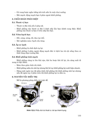 133
− Gâ vang hoÆc nghe tiÕng ãch ¸ch nÕu lµ ruét chui xuèng.
− B¾t m¹ch: ®éng m¹ch bÑn ë phÝa ngoµi khèi phång.
5. ChÈn ®o¸n ph©n biÖt
5.1. Tho¸t vÞ bÑn
− Tho¸t vÞ ®ïi chñ yÕu ë phô n÷.
− Khèi phång cña tho¸t vÞ ®ïi ë d−íi nÕp l»n bÑn (d−íi cung ®ïi). Khèi
phång cña tho¸t vÞ bÑn ë trªn nÕp l»n bÑn.
5.2. Viªm h¹ch bÑn
− Sèt, s−ng, nãng, ®á, ®au t¹i chç.
− XÐt nghiÖm m¸u: b¹ch cÇu t¨ng.
5.3. ¸p xe l¹nh
− Khèi phång lµ chÊt dÞch tô l¹i.
− Khèi phång ë phÝa ngoµi ®éng m¹ch ®ïi v× dÞch lao tõ cét sèng theo c¬
th¾t l−ng chËu xuèng ®ïi.
5.4. Khèi phång tÜnh m¹ch
Khèi phång còng to lªn khi rÆn, khi ho hoÆc khi ®i l¹i, Ên còng mÊt ®i
xong cã ®Æc ®iÓm:
− KÌm theo gi·n tÜnh chi d−íi.
− Khèi phång mÒm Ên nhá l¹i nh−ng khi bá tay khèi phång l¹i xuÊt hiÖn nhanh.
− Dïng mét ngãn tay ®Ì phÝa d−íi chç phång th× khèi phång nhá l¹i nh−ng
nÕu ®Ì ngãn tay ë phÝa trªn th× khèi phång l¹i to dÇn ra.
6. Nguyªn t¾c ®iÒu trÞ
Mæ lµ ph−¬ng ph¸p ®iÒu trÞ triÖt ®Ó.
H×nh 12.6. PhÉu tÝch tói tho¸t vÞ- t¸i t¹o thµnh bông
 