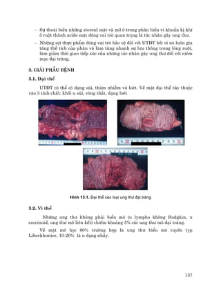 137
− Sù tho¸i biÕn nh÷ng steroid mËt vµ mì ë trong ph©n biÕn vi khuÈn kÞ khÝ
ë ruét thµnh acide mËt ®ãng vai trß quan träng lµ t¸c nh©n g©y ung th−.
− Nh÷ng sîi thùc phÈm ®ãng vai trß b¶o vÖ ®èi víi UT§T bëi v× nã lu«n gia
t¨ng thÓ tÝch cña ph©n vµ lµm t¨ng nhanh sù l−u th«ng trong lßng ruét,
lµm gi¶m thêi gian tiÕp xóc cña nh÷ng t¸c nh©n g©y ung th− ®èi víi niªm
m¹c ®¹i trµng.
3. Gi¶i phÉu bÖnh
3.1. §¹i thÓ
UT§T cã thÓ cã d¹ng sïi, th©m nhiÔm vµ loÐt. VÒ mÆt ®¹i thÓ tïy thuéc
vµo 3 tÝnh chÊt: khèi u sïi, vßng th¾t, d¹ng loÐt
H×nh 13.1. §¹i thÓ c¸c lo¹i ung th− ®¹i trµng
3.2. Vi thÓ
Nh÷ng ung th− kh«ng ph¶i biÓu m« (u lympho kh«ng Hodgkin, u
carcinoid, ung th− m« liªn kÕt) chiÕm kho¶ng 5% c¸c ung th− m« ®¹i trµng.
VÒ mÆt m« häc 80% tr−êng hîp lµ ung th− biÓu m« tuyÕn typ
Liberkhunier, 10-20% lµ u d¹ng nhÇy.
 
