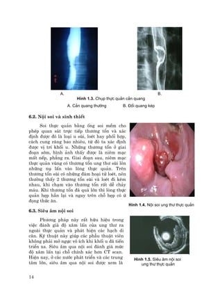 14
A. B.
H×nh 1.3. Chôp thùc qu¶n c¶n quang
A. C¶n quang th−êng B. §èi quang kÐp
6.2. Néi soi vµ sinh thiÕt
Soi thùc qu¶n b»ng èng soi mÒm cho
phÐp quan s¸t trùc tiÕp th−¬ng tæn vµ x¸c
®Þnh ®−îc ®ã lµ lo¹i u sïi, loÐt hay phèi hîp,
c¸ch cung r¨ng bao nhiªu, tõ ®ã ta x¸c ®Þnh
®−îc vÞ trÝ khèi u. Nh÷ng th−¬ng tæn ë giai
®o¹n sím, h×nh ¶nh thÊy ®−îc lµ niªm m¹c
mÊt nÕp, ph¼ng ra. Giai ®o¹n sau, niªm m¹c
thùc qu¶n vïng cã th−¬ng tæn ung th− sïi lªn
nh÷ng nô lÊn vµo lßng thùc qu¶n. Trªn
th−¬ng tæn sïi cã nh÷ng ®¸m ho¹i tö loÐt, nªn
th−êng thÊy 2 th−¬ng tæn sïi vµ loÐt ®i kÌm
nhau, khi ch¹m vµo th−¬ng tæn rÊt dÔ ch¶y
m¸u. Khi th−¬ng tæn ®· qu¸ lín th× lßng thùc
qu¶n hÑp h¼n l¹i vµ ngay trªn chç hÑp cã ø
®äng thøc ¨n.
6.3. Siªu ©m néi soi
Ph−¬ng ph¸p nµy rÊt h÷u hiÖu trong
viÖc ®¸nh gi¸ ®é x©m lÊn cña ung th− ra
ngoµi thùc qu¶n vµ ph¸t hiÖn c¸c h¹ch di
c¨n. Kü thuËt nµy gióp c¸c phÉu thuËt viªn
kh«ng ph¶i më ngùc v« Ých khi khèi u ®· tiÕn
triÓn xa. Siªu ©m qua néi soi ®¸nh gi¸ møc
®é x©m lÊn t¹i chç chÝnh x¸c h¬n CT scan.
HiÖn nay, ë c¸c n−íc ph¸t triÓn vµ c¸c trung
t©m lín, siªu ©m qua néi soi ®−îc xem lµ
H×nh 1.4. Néi soi ung th− thùc qu¶n
H×nh 1.5. Siªu ©m néi soi
ung th− thùc qu¶n
 