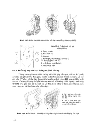 142
H×nh 13.7. PhÉu thuËt hë: c¾t - kh©u nèi ®¹i trµng b»ng dông cô (GIA)
H×nh 13.8. PhÉu thuËt néi soi
c¾t ®¹i trµng
A. Dông cô viªn
B. Mµn h×nh ti vi
C. Camera
D. Ng−êi phô thø nhÊt (gi÷ camera C
vµ dông cô phÉu tÝch E)
E vµ G. Dông cô phÉu tÝch.
F. PhÉu thuËt viªn
6.1.3. §iÒu trÞ ung th− ®¹i trµng cã biÕn chøng
Trong tr−êng hîp cã biÕn chøng nh− §T g©y t¾c ruét ®èi víi §T ph¶i
sau khi båi phô n−íc, ®iÖn gi¶i, chuÈn bÞ tèt bÖnh nh©n ®Ó mæ cÊp cøu. Cã thÓ
c¾t nöa §T ph¶i nèi l¹i l−u th«ng tiªu ho¸ b»ng håi trµng §T ngang. NÕu khèi
u x©m lÊn réng kh«ng thÓ c¾t bá ®−îc th× nèi håi trµng - §T ngang. NÕu ung
th− §T tr¸i g©y t¾c, cã thÓ c¾t bá §T tr¸i kÌm khèi u; tèt nhÊt ®−a hai ®Çu
ruét ra ngoµi vµ lµm hËu m«n nh©n t¹o.
H×nh 13.9. PhÉu thuËt 2 th× trong tr−êng hîp ung th− §T tr¸i thÊp g©y t¾c ruét
A: Th× 1: Më hËu m«n nh©n
t¹o ®¹i trµng sigma trªn
chç t¾c
B: Th× 2: C¾t ®o¹n ®¹i
trµng tr¸i thÊp kÌm khèi u
vµ hËu m«n nh©n t¹o
 