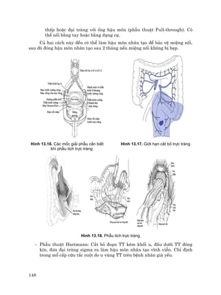 148
thÊp hoÆc ®¹i trµng víi èng hËu m«n (phÉu thuËt Pull-through). Cã
thÓ nèi b»ng tay hoÆc b»ng dông cô.
C¶ hai c¸ch nµy ®Òu cã thÓ lµm hËu m«n nh©n t¹o ®Ó b¶o vÖ miÖng nèi,
sau ®ã ®ãng hËu m«n nh©n t¹o sau 2 th¸ng nÕu miÖng nèi kh«ng bÞ hÑp.
H×nh 13.16. C¸c mèc gi¶i phÉu cÇn biÕt H×nh 13.17. Giíi h¹n c¾t bá trùc trµng
khi phÉu tÝch trùc trµng
H×nh 13.18. PhÉu tÝch trùc trµng
− PhÉu thuËt Hartmann: C¾t bá ®o¹n TT kÌm khèi u, ®Çu d−íi TT ®ãng
kÝn, ®−a ®¹i trµng sigma ra lµm hËu m«n nh©n t¹o vÜnh viÔn. ChØ ®Þnh
trong mæ cÊp cøu t¾c ruét do u vïng TT trªn bÖnh nh©n giµ yÕu.
 