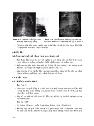 158
H×nh 14.2. Teo thùc qu¶n trªn phim
X quang ngùc-bông th¼ng
H×nh 14.3. H×nh ¶nh ®Çu x«ng ngõng trong teo
thùc qu¶n vµ h¬i d−íi ruét trong teo typ III, IV vµ V
− Siªu ©m: chñ yÕu phôc vô cho viÖc ph¸t hiÖn c¸c dÞ tËt kÌm theo, ®Æc biÖt
lµ dÞ tËt tim m¹ch vµ thËn-tiÕt niÖu.
4. §iÒu trÞ
4.1. VËn chuyÓn bÖnh nh©n vµ s¨n sãc tr−íc mæ
− TrÎ ®−îc ®Æt x«ng d¹ dµy (cã nghÜa lµ ®Æt x«ng vµo tói bÞt thùc qu¶n
trªn) hót ng¾t qu·ng, nÕu cÇn cã thÓ hót liªn tôc víi ¸p lùc nhÑ.
− TrÎ ®−îc truyÒn dÞch, ®iÖn gi¶i vµ ®−êng ®Ó nu«i d−ìng. Cho kh¸ng sinh
®Ó ®iÒu trÞ còng nh− dù phßng viªm phæi do hÝt, sÆc.
− VËn chuyÓn trÎ ë t− thÕ ®Çu cao (nöa n»m) hay còng cã thÓ cho trÎ n»m
nh−ng víi ®Çu nghiªng tr¸i vµ h¬i thÊp so víi th©n.
4.2. PhÉu thuËt
4.2.1.ChØ ®Þnh phÉu thuËt
Typ I vµ II
− PhÇn lín t¸c gi¶ ®ång ý lµ chØ nªn lµm më th«ng thùc qu¶n cæ vµ më
th«ng d¹ dµy nu«i d−ìng trong giai ®o¹n s¬ sinh. Sau 4-12 th¸ng, t¹o
h×nh thay thÕ thùc qu¶n.
− Mét sè t¸c gi¶ mæ nèi ngay th× ®Çu, tuy nhiªn, tû lÖ thÊt b¹i còng nh−
biÕn chøng cao.
Typ III vµ IV
− Xu h−íng hiÖn nay: phÉu thuËt ®ãng ®−êng rß vµ nèi mét th×
− Tr−êng hîp trÎ qu¸ thiÕu c©n (< 2000g) vµ/hoÆc t×nh tr¹ng toµn th©n hay
h« hÊp xÊu, cã thÓ chØ më th«ng d¹ dµy nu«i d−ìng vµ hót ®Çu trªn liªn
 