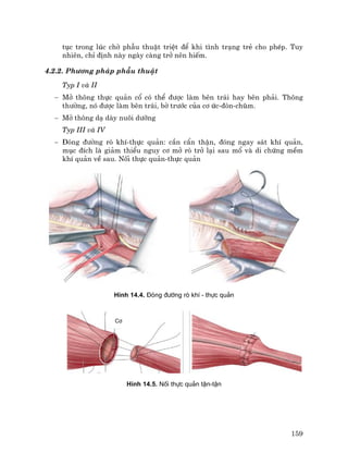 159
tôc trong lóc chê phÉu thuËt triÖt ®Ó khi t×nh tr¹ng trÎ cho phÐp. Tuy
nhiªn, chØ ®Þnh nµy ngµy cµng trë nªn hiÕm.
4.2.2. Ph−¬ng ph¸p phÉu thuËt
Typ I vµ II
− Më th«ng thùc qu¶n cæ cã thÓ ®−îc lµm bªn tr¸i hay bªn ph¶i. Th«ng
th−êng, nã ®−îc lµm bªn tr¸i, bê tr−íc cña c¬ øc-®ßn-chòm.
− Më th«ng d¹ dµy nu«i d−ìng
Typ III vµ IV
− §ãng ®−êng rß khÝ-thùc qu¶n: cÇn cÈn thËn, ®ãng ngay s¸t khÝ qu¶n,
môc ®Ých lµ gi¶m thiÓu nguy c¬ më rß trë l¹i sau mæ vµ di chøng mÒm
khÝ qu¶n vÒ sau. Nèi thùc qu¶n-thùc qu¶n
H×nh 14.4. §ãng ®−êng rß khÝ - thùc qu¶n
H×nh 14.5. Nèi thùc qu¶n tËn-tËn
C¬
 