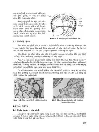165
m¹ch phæi tû lÖ thuËn víi sè l−îng
tiÓu phÕ qu¶n, v× vËy nã còng
gi¶m khi thiÓu s¶n phæi.
T¨ng ¸p phæi lµ hËu qu¶ cña
t×nh tr¹ng thiÓu s¶n phæi. C¬ chÕ
lµ do t×nh tr¹ng gi¶m sè l−îng
m¹ch m¸u phæi vµ gi−êng mao
m¹ch, còng nh− sù gia t¨ng sù c¶n
thµnh m¹ch do sù dµy lªn bÊt
th−êng cña thµnh m¹ch.
H×nh 15.2. Tho¸t vÞ c¬ hoµnh bªn tr¸i
3.2. Sinh lý bÖnh
Sau sinh, do phæi bªn bÞ tho¸t vÞ hoµnh bÈm sinh bÞ chÌn Ðp kÌm víi teo,
trung thÊt bÞ ®Èy sang bªn ®èi diÖn, nªn trÎ h« hÊp rÊt khã kh¨n. ¸p lùc hÝt
vµo trë nªn ©m tÝnh l¹i lµm cho t¹ng cµng thªm tho¸t vÞ lªn ngùc.
MÆt kh¸c, do ph¶i g¾ng søc nªn trÎ nuèt vµo nhiÒu kh«ng khÝ h¬n b×nh
th−êng, lµm cho bông tr−íng vµ chÌn Ðp h« hÊp ngùc.
Ngay c¶ khi phæi ph¸t triÓn t−¬ng ®èi b×nh th−êng, b¶n th©n tho¸t vÞ
hoµnh ®· lµm cho h« hÊp bÞ chÌn Ðp vµ suy h« hÊp, tr−êng hîp tho¸t vÞ hoµnh
bÈm sinh, th−êng phæi cã t×nh tr¹ng thiÓu s¶n cho nªn l¹i cµng lµm trÇm träng
thªm t×nh tr¹ng thiÕu oxy còng nh− gi¶m th¶i CO2.
Do sè l−îng mao m¹ch phæi gi¶m, nªn t©m thÊt ph¶i gia t¨ng ¸p lùc tèng
m¸u ®Õn gi−êng mao m¹ch nhá h¬n b×nh th−êng, mµ hËu qu¶ lµ lµm t¨ng ¸p
phæi vµ t¨ng ¸p thÊt ph¶i.
H×nh 15.3. Nhu m« phæi ë trÎ b×nh th−êng H×nh 15.4. Nhu m« phæi ë trÎ tho¸t vÞ
hoµnh bÈm sinh
4. ChÈn ®o¸n
4.1. ChÈn ®o¸n tr−íc sinh
Cïng víi sù ph¸t triÓn ngµy cµng m¹nh cña siªu ©m bµo thai, ®Æc biÖt lµ
siªu ©m 3 chiÒu, ngµy cµng cã nhiÒu tr−êng hîp tho¸t vÞ hoµnh bÈm sinh ®−îc
chÈn ®o¸n trong thêi kú bµo thai.
Phæi
Gan
L¸ch
Ruét
non
Ruét giµ
 
