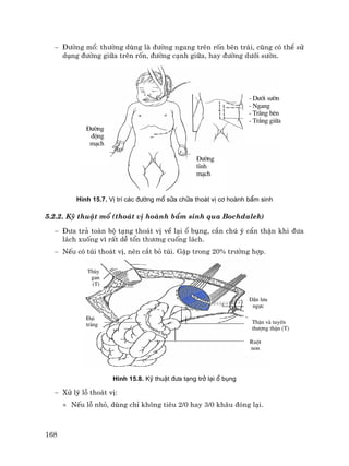 168
− §−êng mæ: th−êng dïng lµ ®−êng ngang trªn rèn bªn tr¸i, còng cã thÓ sö
dông ®−êng gi÷a trªn rèn, ®−êng c¹nh gi÷a, hay ®−êng d−íi s−ên.
H×nh 15.7. VÞ trÝ c¸c ®−êng mæ söa ch÷a tho¸t vÞ c¬ hoµnh bÈm sinh
5.2.2. Kü thuËt mæ (tho¸t vÞ hoµnh bÈm sinh qua Bochdalek)
− §−a tr¶ toµn bé t¹ng tho¸t vÞ vÒ l¹i æ bông, cÇn chó ý cÈn thËn khi ®−a
l¸ch xuèng v× rÊt dÔ tæn th−¬ng cuèng l¸ch.
− NÕu cã tói tho¸t vÞ, nªn c¾t bá tói. GÆp trong 20% tr−êng hîp.
H×nh 15.8. Kü thuËt ®−a t¹ng trë l¹i æ bông
− Xö lý lç tho¸t vÞ:
+ NÕu lç nhá, dïng chØ kh«ng tiªu 2/0 hay 3/0 kh©u ®ãng l¹i.
- D−íi s−ên
- Ngang
- Tr¾ng bªn
- Tr¾ng gi÷a
§−êng
®éng
m¹ch
§−êng
tÜnh
m¹ch
Thïy
gan
(T)
§¹i
trµng
DÉn l−u
ngùc
ThËn &
TTT (T)
Ruét
non
ThËn vµ tuyÕn
th−îng thËn (T)
 
