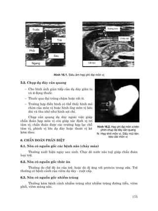 175
H×nh 16.1. Siªu ©m hÑp ph× ®¹i m«n vÞ
5.2. Chôp d¹ dµy c¶n quang
− Cho h×nh ¶nh gi¸n tiÕp cña d¹ dµy gi·n to
vµ ø ®äng thuèc.
− Thuèc qua ®¹i trµng chËm hoÆc rÊt Ýt.
− Tr−êng hîp ®iÒn h×nh cã thÓ thÊy h×nh má
chim cña m«n vÞ hoÆc h×nh èng m«n vÞ kÐo
dµi vµ thu nhá nh− h×nh sîi chØ.
Chôp c¶n quang d¹ dµy ngoµi viÖc gióp
chÈn ®o¸n hÑp m«n vÞ cßn gióp x¸c ®Þnh vÞ trÝ
t©m vÞ; chÈn ®o¸n ®−îc c¸c tr−êng hîp l¹c chç
t©m vÞ, ph×nh vÞ lín d¹ dµy hoÆc tho¸t vÞ kÏ
kÌm theo.
6. ChÈn ®o¸n ph©n biÖt
6.1. N«n cã nguån gèc c¸c bÖnh n·o (ch¶y m¸u)
Th−êng xuÊt hiÖn ngay sau sinh. Chäc dß n−íc n·o tuû gióp chÈn ®o¸n
lo¹i trõ.
6.2. N«n cã nguån gèc thøc ¨n
Th−êng do chÕ ®é ¨n cña trÎ, hoÆc do dÞ øng víi protein trong s÷a. TrÎ
th−êng cã bÖnh c¶nh cña viªm d¹ dµy - ruét cÊp.
6.3. N«n cã nguån gèc nhiÔm trïng
Th−êng kÌm bÖnh c¶nh nhiÔm trïng nh− nhiÔm trïng ®−êng tiÓu, viªm
phæi, viªm mµng n·o.
Tr−íc
Sau
Tr¸i
Ph¶i
Ngang
§−êng kÝnh
ChiÒu dµi
C¾t däc
H×nh 16.2. HÑp ph× ®¹i m«n vÞ trªn
phim chôp d¹ dµy c¶n quang
N: HÑp khÝt m«n vÞ. DÊu mòi tªn:
kÐo dµi m«n vÞ
 