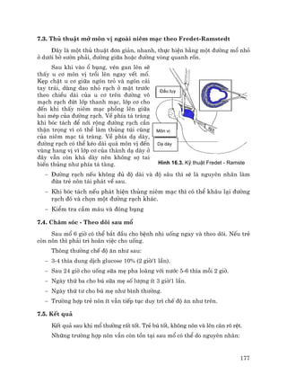 177
7.3. Thñ thuËt më m«n vÞ ngoµi niªm m¹c theo Fredet-Ramstedt
§©y lµ mét thñ thuËt ®¬n gi¶n, nhanh, thùc hiÖn b»ng mét ®−êng mæ nhá
ë d−íi bê s−ên ph¶i, ®−êng gi÷a hoÆc ®−êng vßng quanh rèn.
Sau khi vµo æ bông, vÐn gan lªn sÏ
thÊy u c¬ m«n vÞ tråi lªn ngay vÕt mæ.
KÑp chÆt u c¬ gi÷a ngãn trá vµ ngãn c¸i
tay tr¸i, dïng dao nhá r¹ch ë mÆt tr−íc
theo chiÒu dµi cña u c¬ trªn ®−êng v«
m¹ch r¹ch ®øt líp thanh m¹c, líp c¬ cho
®Õn khi thÊy niªm m¹c phång lªn gi÷a
hai mÐp cña ®−êng r¹ch. VÒ phÝa t¸ trµng
khi bãc t¸ch ®Ó níi réng ®−êng r¹ch cÇn
thËn träng v× cã thÓ lµm thñng tói cïng
cña niªm m¹c t¸ trµng. VÒ phÝa d¹ dµy,
®−êng r¹ch cã thÓ kÐo dµi qu¸ m«n vÞ ®Õn
vïng hang vÞ v× líp c¬ cña thµnh d¹ dµy ë
®©y vÉn cßn kh¸ dµy nªn kh«ng sî tai
biÕn thñng nh− phÝa t¸ tµng.
− §−êng r¹ch nÕu kh«ng ®ñ ®é dµi vµ ®é s©u th× sÏ lµ nguyªn nh©n lµm
®øa trÎ n«n t¸i ph¸t vÒ sau.
− Khi bãc t¸ch nÕu ph¸t hiÖn thñng niªm m¹c th× cã thÓ kh©u l¹i ®−êng
r¹ch ®ã vµ chän mét ®−êng r¹ch kh¸c.
− KiÓm tra cÇm m¸u vµ ®ãng bông
7.4. Ch¨m sãc - Theo dâi sau mæ
Sau mæ 6 giê cã thÓ b¾t ®Çu cho bÖnh nhi uèng ngay vµ theo dâi. NÕu trÎ
cßn n«n th× ph¶i tr× ho·n viÖc cho uèng.
Th«ng th−êng chÕ ®é ¨n nh− sau:
− 3-4 th×a dung dÞch glucose 10% (2 giê/1 lÇn).
− Sau 24 giê cho uèng s÷a mÑ pha lo·ng víi n−íc 5-6 th×a mçi 2 giê.
− Ngµy thø ba cho bó s÷a mÑ sè l−îng Ýt 3 giê/1 lÇn.
− Ngµy thø t− cho bó mÑ nh− b×nh th−êng.
− Tr−êng hîp trÎ n«n Ýt vÉn tiÕp tôc duy tr× chÕ ®é ¨n nh− trªn.
7.5. KÕt qu¶
KÕt qu¶ sau khi mæ th−êng rÊt tèt. TrÎ bó tèt, kh«ng n«n vµ lªn c©n râ rÖt.
Nh÷ng tr−êng hîp n«n vÉn cßn tån t¹i sau mæ cã thÓ do nguyªn nh©n:
Âáöu tuûy
M än
vë
Daûdaìy
H×nh 16.3. Kü thuËt Fredet - Ramste
§Çu tôy
M«n vÞ
D¹ dµy
 