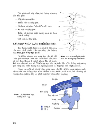 182
C¸c d−íi-thÓ tïy theo sù th«ng th−¬ng
cña ®Çu gÇn:
− C¸c èng gan gi·n.
− ThiÓu s¶n c¸c èng gan.
− DÞ d¹ng kiÓu t¹o "hå mËt" ë rèn gan.
− X¬ ho¸ c¸c èng gan.
− Toµn bé ®−êng mËt ngoµi gan x¬ ho¸
thµnh m¶ng.
− BÊt s¶n c¸c èng gan.
3. Nguyªn nh©n vµ c¬ chÕ bÖnh sinh
Teo ®−êng mËt ®−îc xem nh− lµ hËu qu¶
cña qu¸ tr×nh ph¸t triÓn t¹o èng cña ®−êng
mËt trong thêi kú t¹o ph«i.
HÖ thèng ®−êng mËt ®−îc t¹o nªn tõ tói
thõa gan cña ruét tr−íc vµo tuÇn thø 4 cña ph«i
vµ biÖt ho¸ thµnh 2 thµnh phÇn ®Çu vµ ®u«i.
Tói mËt, èng tói mËt vµ ¤MC ®−îc t¹o nªn tõ phÇn ®Çu. Cßn ®−êng mËt trong
gan còng nh− phÇn ®−êng mËt ngoµi gan cßn l¹i ®−îc t¹o nªn tõ phÇn ®u«i.
Ngoµi ra, mét sè yÕu tè còng ®−îc xem nh− lµ cã liªn quan ®Õn nguyªn
nh©n cña teo ®−êng mËt nh− nhiÔm virus, thiÕu t−íi m¸u, bÊt th−êng vÒ
chuyÓn ho¸ mËt vµ tån t¹i kªnh mËt-tuþ chung bÊt th−êng.
H×nh 17.2. Ph«i thai häc
®−êng mËt - tôy
H×nh 17.1. C¸c thÓ gi¶i phÉu
cña teo ®−êng mËt bÈm sinh
D¹dµy
BÌgan
B¶nngang
èngmËtchñ
Trungb×
Néib×
TóimËt
Tôybông
Tôyl−ng
D¹ dµy
BÌ gan
B¶n ngang
èng mËt chñ
Tói mËt
Tuþ bông
Tuþ l−ng
Trung b×
Néi b×
A
B
C
 