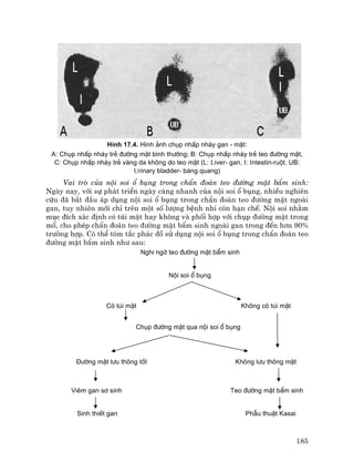 185
H×nh 17.4. H×nh ¶nh chôp nhÊp nh¸y gan - mËt:
A: Chôp nhÊp nh¸y trÎ ®−êng mËt b×nh th−êng; B: Chôp nhÊp nh¸y trÎ teo ®−êng mËt,
C: Chôp nhÊp nh¸y trÎ vµng da kh«ng do teo mËt (L: liver- gan, I: intestin-ruét, UB:
urinary bladder- bµng quang)
Vai trß cña néi soi æ bông trong chÈn ®o¸n teo ®−êng mËt bÈm sinh:
Ngµy nay, víi sù ph¸t triÓn ngµy cµng nhanh cña néi soi æ bông, nhiÒu nghiªn
cøu ®· b¾t ®Çu ¸p dông néi soi æ bông trong chÈn ®o¸n teo ®−êng mËt ngoµi
gan, tuy nhiªn míi chØ trªn mét sè l−îng bÖnh nhi cßn h¹n chÕ. Néi soi nh»m
môc ®Ých x¸c ®Þnh cã tói mËt hay kh«ng vµ phèi hîp víi chôp ®−êng mËt trong
mæ, cho phÐp chÈn ®o¸n teo ®−êng mËt bÈm sinh ngoµi gan trong ®Õn h¬n 90%
tr−êng hîp. Cã thÓ tãm t¾c ph¸c ®å sö dông néi soi æ bông trong chÈn ®o¸n teo
®−êng mËt bÈm sinh nh− sau:
Nghi ngê teo ®−êng mËt bÈm sinh
Néi soi æ bông
Cã tói mËt Kh«ng cã tói mËt
Chôp ®−êng mËt qua néi soi æ bông
§−êng mËt l−u th«ng tèt Kh«ng l−u th«ng mËt
Viªm gan s¬ sinh Teo ®−êng mËt bÈm sinh
Sinh thiÕt gan PhÉu thuËt Kasai
 