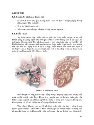 187
6. §iÒu trÞ
6.1. ChuÈn bÞ bÖnh nhi tr−íc mæ
− Vitamin K ®−îc cho qua ®−êng toµn th©n víi liÒu 1-2mg/kg/ngµy trong
nh÷ng ngµy ®Çu chê mæ.
− NhÞn ¨n 24 giê tr−íc mæ.
− §iÒu chØnh c¸c rèi lo¹n vÒ dinh d−ìng vµ xÐt nghiÖm.
6.2. PhÉu thuËt
ChØ ®Þnh: tr−íc ®©y, phÇn lín t¸c gi¶ cho r»ng phÉu thuËt chØ cã thÓ
thµnh c«ng ë nh÷ng bÖnh nhi ®−îc phÉu thuËt tr−íc th¸ng thø 4, cã nghÜa lµ
mæ tr−íc 90 ngµy tuæi. Tuy nhiªn, gÇn ®©y, mét sè nghiªn cøu l¹i cho thÊy tû
lÖ thµnh c«ng vÉn cßn cao ë nh÷ng bÖnh nhi ®−îc phÉu thuËt muén h¬n, thËm
chÝ cho ®Õn 120 ngµy tuæi. ChÝnh v× vËy, phÉu thuËt vÉn ®−îc chØ ®Þnh ë
nh÷ng bÖnh nhi ®−îc chÈn ®o¸n muén, ®Æc biÖt lµ ë nh÷ng bÖnh nhi ®−îc chÈn
®o¸n trong kho¶ng tõ 90-120 ngµy tuæi.
H×nh 17.5. PhÉu thuËt Kasai
PhÉu thuËt nèi èng gan chung - hçng trµng: ®−îc ¸p dông cho nh÷ng thÓ
®−îc gäi lµ cã thÓ ch÷a ®−îc. PhÉu tÝch vµo rèn gan cã thÓ t×m thÊy mét cÊu
tróc d¹ng nang mµ khi c¾t ngang th× cho thÊy cã ch¶y mËt ra ngoµi. Nang nµy
kh«ng ®−îc c¾t bá mµ ph¶i ®−îc sö dông ®Ó nèi víi ruét.
PhÉu thuËt Kasai: cßn gäi lµ ph−¬ng ph¸p nèi rèn gan - hçng trµng
(porto-jejunostomy). PhÉu thuËt theo ph−¬ng ph¸p Kasai ®−îc ¸p dông cho
nh÷ng thÓ ®−îc gäi lµ kh«ng thÓ ch÷a khái ®−îc cña teo ®−êng mËt bÈm sinh.
 
