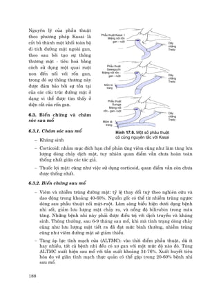 188
Nguyªn lý cña phÉu thuËt
theo ph−¬ng ph¸p Kasai lµ
c¾t bá thµnh mét khèi toµn bé
di tÝch ®−êng mËt ngoµi gan,
theo sau bëi t¹o sù th«ng
th−¬ng mËt - tiªu ho¸ b»ng
c¸ch sö dông mét quai ruét
non ®Õn nèi víi rèn gan,
trong ®ã sù th«ng th−¬ng nµy
®−îc ®¶m b¶o bëi sù tån t¹i
cña c¸c cÊu tróc ®−êng mËt ë
d¹ng vi thÓ ®−îc t×m thÊy ë
diÖn c¾t cña rèn gan.
6.3. BiÕn chøng vµ ch¨m
sãc sau mæ
6.3.1. Ch¨m sãc sau mæ
− Kh¸ng sinh
− Corticoid: nh»m môc ®Ých h¹n chÕ ph¶n øng viªm còng nh− lµm t¨ng l−u
l−îng dßng ch¶y dÞch mËt, tuy nhiªn quan ®iÓm vÉn ch−a hoµn toµn
thèng nhÊt gi÷a c¸c t¸c gi¶.
− Thuèc lîi mËt: còng nh− viÖc sö dông corticoid, quan ®iÓm vÉn cßn ch−a
®−îc thèng nhÊt.
6.3.2. BiÕn chøng sau mæ
− Viªm vµ nhiÔm trïng ®−êng mËt: tû lÖ thay ®æi tuú theo nghiªn cøu vµ
dao ®éng trong kho¶ng 40-60%. Nguån gèc cã thÓ tõ nhiÔm trïng ngù¬c
dßng sau phÉu thuËt nèi mËt-ruét. L©m sµng biÓu hiÖn d−íi d¹ng bÖnh
nhi sèt, gi¶m l−u l−îng mËt ch¶y ra, vµ nång ®é bilirubin trong m¸u
t¨ng. Nh÷ng bÖnh nhi nµy ph¶i ®−îc ®iÒu trÞ víi dÞch truyÒn vµ kh¸ng
sinh. Th«ng th−êng, sau 6-9 th¸ng sau mæ, khi mµ t×nh tr¹ng dßng ch¶y
còng nh− l−u l−îng mËt tiÕt ra ®· ®¹t møc b×nh th−êng, nhiÔm trïng
còng nh− viªm ®−êng mËt sÏ gi¶m thiÓu.
− T¨ng ¸p lùc tÜnh m¹ch cöa (ALTMC): vµo thêi ®iÓm phÉu thuËt, dï Ýt
hay nhiÒu, tÊt c¶ bÖnh nhi ®Òu cã x¬ gan víi mét møc ®é nµo ®ã. T¨ng
ALTMC xuÊt hiÖn sau mæ víi tÇn suÊt kho¶ng 34-76%. XuÊt huyÕt tiªu
hãa do vì gi·n tÜnh m¹ch thùc qu¶n cã thÓ gÆp trong 20-60% bÖnh nhi
sau mæ.
H×nh 17.6. Mét sè phÉu thuËt
cã cïng nguyªn t¾c víi Kasai
D©y
ch»ng
Treitz
D©y
ch»ng
Treitz
PhÉu thuËt
Sawaguchi
MiÖng nèi rèn -
gan - ruét
Mám t¸
trµng
Mám t¸
trµng
PhÉu thuËt
Suruga
MiÖng nèi
rèn - gan- ruét
PhÉu thuËt Kasai I
MiÖng nèi rèn
gan - ruét
D©y
ch»ng
Treitz
 