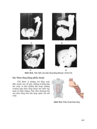 197
A B
C D
H×nh 18.4. TiÕn triÓn cña th¸o lång b»ng Baryte ( A-B-C-D)
5.2. Th¸o lång b»ng phÉu thuËt
ChØ ®Þnh: ë nh÷ng trÎ lång ruét
®Õn muén sau 48 giê, nh÷ng tr−êng hîp
t¾c ruét, cã dÊu nhiÔm ®éc hoÆc nh÷ng
tr−êng hîp th¸o lång b»ng h¬i thÊt b¹i
hoÆc cã biÕn chøng. Tïy theo th−¬ng tæn
mµ th¸o lång b¶o tån hoÆc ph¶i c¾t nèi
ruét.
H×nh 18.5. PhÉu thuËt th¸o lång
 