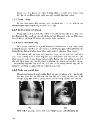 202
− ChËm ®µo th¶i ph©n su: b×nh th−êng ph©n su xuÊt hiÖn trong vßng
12 - 24 giê mµ kh«ng thÊy ph©n su ë hËu m«n lµ dÊu hiÖu chËm.
2.2.2. Bông tr−íng
Lµ dÊu hiÖu muén, dÊu hiÖu nµy cßn tïy thuéc vµo vÞ trÝ t¾c, nÕu t¾c cao
th× th−êng bông kh«ng tr−íng mµ ®«i khi l¹i xÑp.
2.2.3. Th¨m kh¸m trùc trµng
Dïng mét sonde NÐlaton nhá cã b«i dÇu nhên ®ót vµo hËu m«n. Tïy theo
lo¹i bÖnh mµ ®Çu sonde sÏ cã dÝnh nhiÒu, Ýt hoÆc kh«ng cã ph©n su. §©y còng
lµ c¸ch kh¸m b¾t buéc ®Ó h−íng tíi nguyªn nh©n g©y bÖnh.
2.2.4. BÖnh c¶nh l©m sµng
SÏ ®−îc gîi ý h¬n tr−íc mét trÎ ®Î non vµ cã tiÒn sö ®a èi cÊp trong trong
nh÷ng th¸ng ®Çu cña thai kú. DÊu hiÖu ®a èi rÊt th−êng gÆp ë nh÷ng tr−êng hîp
bÖnh nhi t¾c ®−êng tiªu hãa ë cao (thùc qu¶n, m«n vÞ, t¸ trµng, hçng trµng).
DÊu hiÖu ®a èi trong t¾c ruét bµo thai ®−îc c¸c t¸c gi¶ gi¶i thÝch nh−
sau: b×nh th−êng n−íc èi ®−îc hÊp thu qua ®−êng tiªu ho¸ cña bµo thai (do
thai nhi nuèt n−íc èi qua ®−êng miÖng). NÕu ®−êng tiªu ho¸ kh«ng cã c¶n trë
th× n−íc èi sÏ ®−îc hÊp thu ®Çy ®ñ vµ trë l¹i vÒ hÖ tuÇn cña nhau thai vµ mÑ.
Trong tr−êng hîp t¾c ruét nhÊt lµ t¾c ë cao th× sè l−îng n−íc èi hÊp thu sÏ
gi¶m ®i vµ ø ®äng l¹i ngµy mét nhiÒu t¹o thµnh ®a èi.
2.2.5. ChÈn ®o¸n h×nh ¶nh
− Chôp bông kh«ng chuÈn bÞ: gióp ®¸nh gi¸ nguyªn nh©n, vÞ trÝ cña chç t¾c
dùa vµo h×nh ¶nh vµ sè l−îng cña møc h¬i n−íc, ®¸m v«i hãa, h¬i tù do
trong æ bông. H×nh ¶nh X quang sÏ ®Æc thï cho tõng lo¹i t¾c ruét s¬ sinh.
(A) (B)
H×nh 19.2. X quang t¾c ruét s¬ sinh do teo hçng trµng (A) vµ teo håi trµng (B)
 
