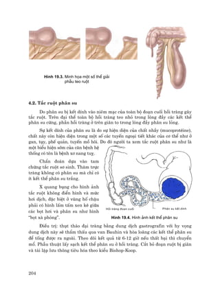 204
Håi trµng ®o¹n cuèi Ph©n su kÕt dÝnh
4.2. T¾c ruét ph©n su
Do ph©n su bÞ kÕt dÝnh vµo niªm m¹c cña toµn bé ®o¹n cuèi håi trµng g©y
t¾c ruét. Trªn ®¹i thÓ toµn bé håi trµng teo nhá trong lßng ®Çy c¸c kÕt thÓ
ph©n su cøng, phÇn håi trµng ë trªn gi·n to trong lßng ®Çy ph©n su láng.
Sù kÕt dÝnh cña ph©n su lµ do sù hiÖn diÖn cña chÊt nhÇy (mucoprotÐine),
chÊt nµy cßn hiÖn diÖn trong mét sè c¸c tuyÕn ngo¹i tiÕt kh¸c cña c¬ thÓ nh− ë
gan, tôy, phÕ qu¶n, tuyÕn må h«i. Do ®ã ng−êi ta xem t¾c ruét ph©n su nh− lµ
mét biÓu hiÖn sím cña c¨n bÖnh hÖ
thèng cã tªn lµ bÖnh x¬ nang tuþ.
ChÈn ®o¸n dùa vµo tam
chøng t¾c ruét s¬ sinh. Th¨m trùc
trµng kh«ng cã ph©n su mµ chØ cã
Ýt kÕt thÓ ph©n su tr¾ng.
X quang bông cho h×nh ¶nh
t¾c ruét kh«ng ®iÓn h×nh vµ møc
h¬i dÞch, ®Æc biÖt ë vïng hè chËu
ph¶i cã h×nh lÊm tÊm xen kÏ gi÷a
c¸c bät h¬i vµ ph©n su nh− h×nh
“bät xµ phßng”. H×nh 19.4. H×nh ¶nh kÕt thÓ ph©n su
§iÒu trÞ: thôt th¸o ®¹i trµng b»ng dung dÞch gastrografin víi hy väng
dung dÞch nµy sÏ thÈm thÊu qua van Bauhin vµ hßa lo·ng c¸c kÕt thÓ ph©n su
®Ó tèng ®−îc ra ngoµi. Theo dâi kÕt qu¶ tõ 6-12 giê nÕu thÊt b¹i th× chuyÓn
mæ. PhÉu thuËt lÊy s¹ch kÕt thÓ ph©n su ë håi trµng. C¾t bá ®o¹n ruét bÞ gi·n
vµ t¸i lËp l−u th«ng tiªu hãa theo kiÓu Bishop-Koop.
H×nh 19.3. Minh häa mét sè thÓ gi¶i
phÉu teo ruét
 