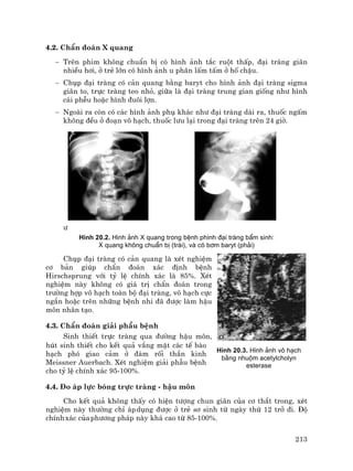 213
4.2. ChÈn ®o¸n X quang
− Trªn phim kh«ng chuÈn bÞ cã h×nh ¶nh t¾c ruét thÊp, ®¹i trµng gi·n
nhiÒu h¬i, ë trÎ lín cã h×nh ¶nh u ph©n lÊm tÊm ë hè chËu.
− Chôp ®¹i trµng cã c¶n quang b»ng baryt cho h×nh ¶nh ®¹i trµng sigma
gi·n to, trùc trµng teo nhá, gi÷a lµ ®¹i trµng trung gian gièng nh− h×nh
c¸i phÔu hoÆc h×nh ®u«i lîn.
− Ngoµi ra cßn cã c¸c h×nh ¶nh phô kh¸c nh− ®¹i trµng dµi ra, thuèc ngÊm
kh«ng ®Òu ë ®o¹n v« h¹ch, thuèc l−u l¹i trong ®¹i trµng trªn 24 giê.
−
H×nh 20.2. H×nh ¶nh X quang trong bÖnh ph×nh ®¹i trµng bÈm sinh:
X quang kh«ng chuÈn bÞ (tr¸i), vµ cã b¬m baryt (ph¶i)
Chôp ®¹i trµng cã c¶n quang lµ xÐt nghiÖm
c¬ b¶n gióp chÈn ®o¸n x¸c ®Þnh bÖnh
Hirschsprung víi tû lÖ chÝnh x¸c lµ 85%. XÐt
nghiÖm nµy kh«ng cã gi¸ trÞ chÈn ®o¸n trong
tr−êng hîp v« h¹ch toµn bé ®¹i trµng, v« h¹ch cùc
ng¾n hoÆc trªn nh÷ng bÖnh nhi ®· ®−îc lµm hËu
m«n nh©n t¹o.
4.3. ChÈn ®o¸n gi¶i phÉu bÖnh
Sinh thiÕt trùc trµng qua ®−êng hËu m«n,
hót sinh thiÕt cho kÕt qu¶ v¾ng mÆt c¸c tÕ bµo
h¹ch phã giao c¶m ë ®¸m rèi thÇn kinh
Meissner Auerbach. XÐt nghiÖm gi¶i phÉu bÖnh
cho tû lÖ chÝnh x¸c 95-100%.
4.4. §o ¸p lùc bãng trùc trµng - hËu m«n
Cho kÕt qu¶ kh«ng thÊy cã hiÖn t−îng chun gi·n cña c¬ th¾t trong, xÐt
nghiÖm nµy th−êng chØ ¸pdông ®−îc ë trÎ s¬ sinh tõ ngµy thø 12 trë ®i. §é
chÝnhx¸c cñaph−¬ng ph¸p nµy kh¸ cao tõ 85-100%.
H×nh 20.3. H×nh ¶nh v« h¹ch
b»ng nhuém acetylcholyn
esterase
 