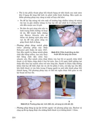 224
+ Th× 2 cña phÉu thuËt phôc håi thµnh bông sÏ tiÕn hµnh sau mét n¨m
khi æ bông ®· t¨ng thÓ tÝch vµ ph¸t triÓn b×nh th−êng. Bªn c¹nh −u
®iÓm ph−¬ng ph¸p nµy còng cã mét sè h¹n chÕ nh−:
• Do ®Ó l¹i líp mµng tói nªn mét sè tr−êng hîp nhiÔm trïng tõ mµng
tói lan ra g©y nhiÔm trïng vµ bôc l¹i vÕt mæ nhÊt lµ ë nh÷ng bÖnh
nhi ®Õn muén sau 24 giê.
• Do kÐo da qu¸ c¨ng nªn x¶y ra
t×nh tr¹ng thiÕu d−ìng vµ ho¹i
tö da. §Ó tr¸nh biÕn chøng
nµy Bairov khuyªn nªn xÎ
thªm vµi ®−êng r¹ch phô trªn
v¹t da ®Ó võa gi¶m c¨ng vµ
gióp tho¸t dÞch ø ®äng.
− Ph−¬ng ph¸p dïng m¶nh ghÐp
(silo): ph−¬ng ph¸p nµy ®−îc
Schuster giíi thiÖu tõ n¨m 1947.
Lóc ®Çu ng−êi ta dïng m¶nh ghÐp
chÊt dÎo b»ng teflon, sau nµy thay
thÕ b»ng chÊt dÎo silon hay
silastic silo. Hai m¶nh silon ®−îc kh©u vµo hai bê c¬ quanh ch©n khèi
tho¸t vÞ råi kh©u chËp dÝnh ë hai bê trªn. Sau 5-10 ngµy khèi phång tôt
thÊp dÇn lµm hai m¶nh silon trë nªn láng lÎo. Ng−êi ta kh©u tiÕp ®−êng
kh©u thø hai ®Ó th¾t chÆt tói vµ c¾t bá phÇn ë trªn, cø tiÕp tôc cho ®Õn
khi khèi tho¸t vÞ vµo h¼n trong æ bông ng−êi ta míi tiÕn hµnh phôc håi
thµnh bông. Víi ph−¬ng ph¸p nµy cã thÓ rót ng¾n ®−îc thêi gian so víi
kü thuËt mæ hai th×.
A B
H×nh 21.3. Ph−¬ng ph¸p silo: kinh ®iÓn (A), sö dông tói chÕ s½n (B)
− Ph−¬ng ph¸p b¨ng Ðp ¸p lùc tõ bªn ngoµi: víi ph−¬ng ph¸p nµy, Barlow vµ
céng sù ®· ¸p dông ®−îc cho nh÷ng khèi tho¸t vÞ cã ®−êng kÝnh > 10cm.
H×nh 21.2. PhÉu thuËt ®ãng da ®¬n
thuÇn ®Ó che t¹ng cña Gross
 