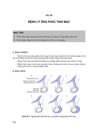 228
Bµi 22
BÖNH Lý èNG PHóC TINH M¹C
Môc tiªu
1. Tr×nh bµy ®−îc nguån gèc bµo thai häc cña bÖnh lý èng phóc tinh m¹c
2. ChÈn ®o¸n ®−îc c¸c bÖnh lý èng phóc tinh m¹c hay gÆp.
1. §¹i c−¬ng
Sù tån t¹i cña èng phóc tinh m¹c lµ mét lo¹i bÖnh lý rÊt th−êng gÆp ë trÎ
em mµ bÖnh c¶nh l©m sµng th−êng biÓu hiÖn b»ng hai h×nh th¸i:
− H×nh th¸i cÊp tÝnh ®ßi hái ph¶i can thiÖp phÉu thuËt nh− tho¸t vÞ bÑn.
− H×nh th¸i m¹n tÝnh mµ sù ph¸t hiÖn th−êng lµ t×nh cê qua th¨m kh¸m
tæng qu¸t nh− u nang thõng tinh.
2. Bµo thai
H×nh 22.1. Nguån gèc bµo thai häc cña bÖnh lý èng phóc tinh m¹c
Mµo tinh
Tinh hoµn
Bao phóc tinh m¹c
èng phóc m¹c tinh
trong qu¸ tr×nh t¾c
Khoang phóc m¹c
 